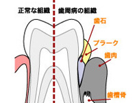 歯ぐきからの出血は歯周病のサイン