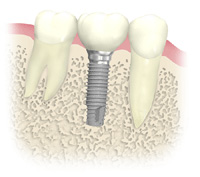 優れた補綴治療「インプラント」
