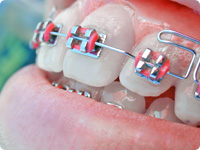 よりおかガーデン歯科クリニックの矯正治療