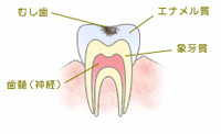 虫歯かもしれません