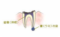 虫歯で歯を失うことも