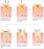 【歯の根の病気の治療法】